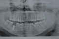 Zirconia crown on two-stage implant
