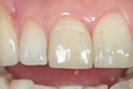 Lithium disilicate veneers