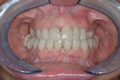Lithium disilicate fixed dentures