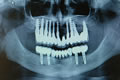 Orbital composite fixed dentures on abutment implants