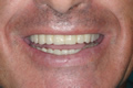Composite fixed dentures on abutment implants