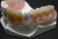 Removable or skeletal dentures